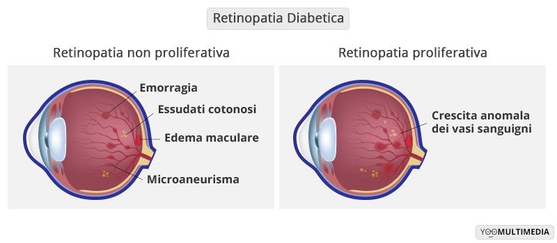 Retinopatia diabetica descrizione, sintomi e cure