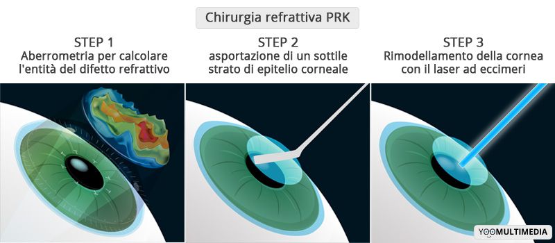 Chirurgia refrattiva PRK con laser ad eccimeri