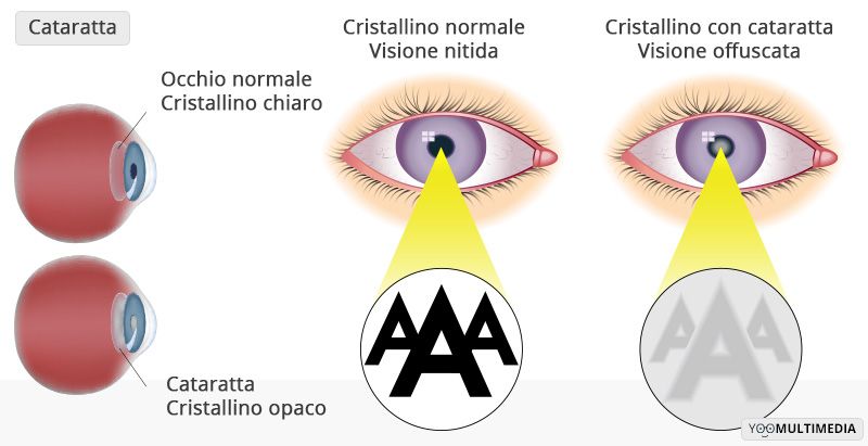Cataratta descrizione, sintomi e cure