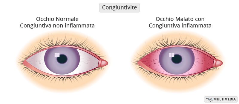 Congiuntivite descrizione, sintomi e cure