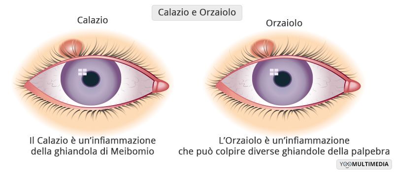 Calazio descrizione, sintomi e cure