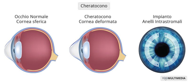Cura Cheratocono con Femto-Laser e impianto anelli intrastromali