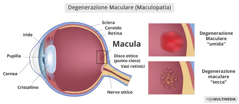 Maculopatia descrizione, sintomi e cure