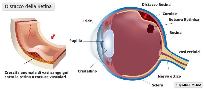 Distacco della retina descrizione, sintomi e cure