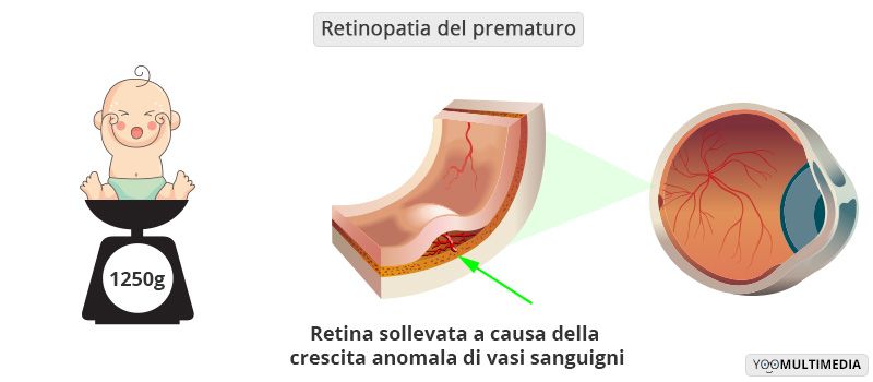 Retinopatia del prematuro descrizione, sintomi e cure