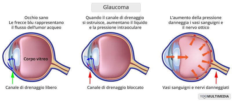 Glaucoma descrizione, sintomi e cure