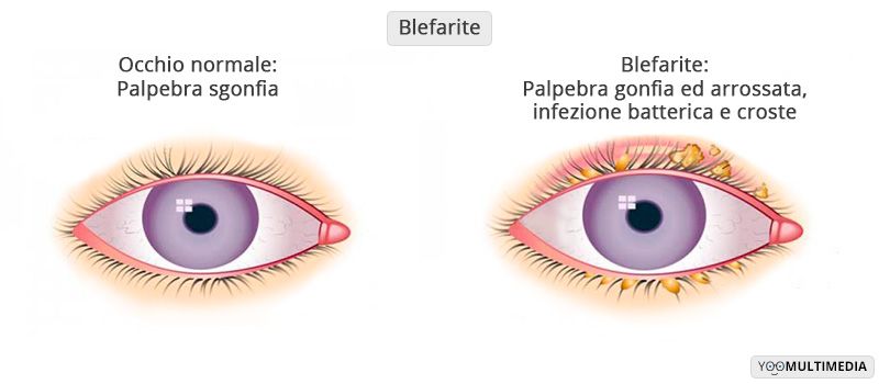 Blefarite descrizione, sintomi e cure