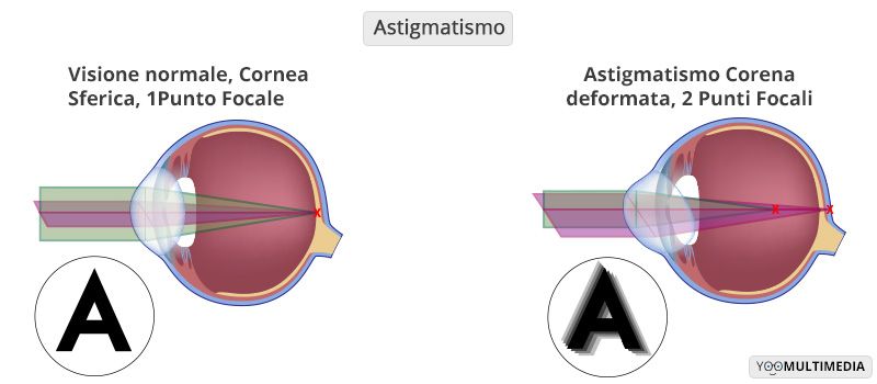 Astigmatismo descrizione, sintomi e cura