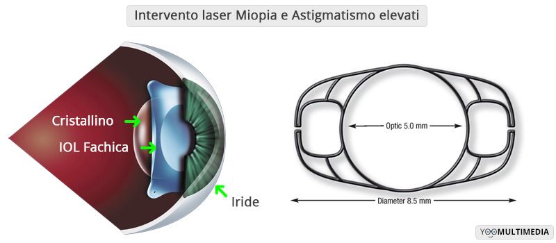 Operazione Miopia Ipermetropia e Astigmatismo elevati con lenti intraoculari fachiche 