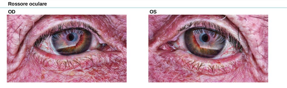 IOL Oculista Piacenza, Lodi, Cremona Ambliopia descrizione, sintomi e cure