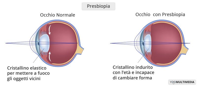 Presbiopia descrizione, sintomi e cure
