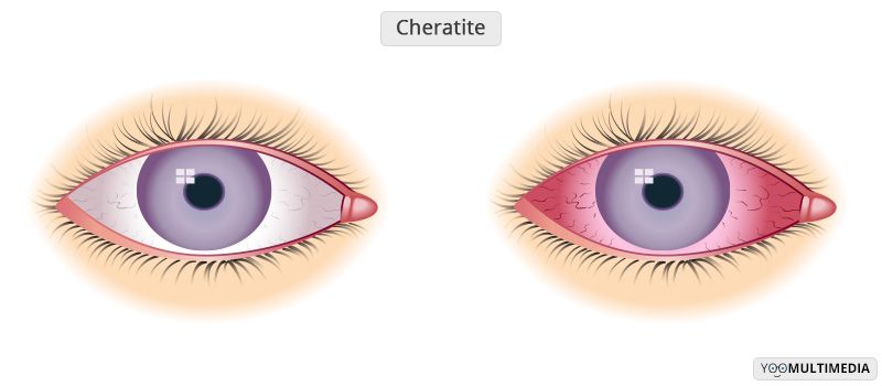 Cheratite descrizione, sintomi e cure