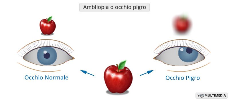 Ambliopia descrizione, sintomi e cure