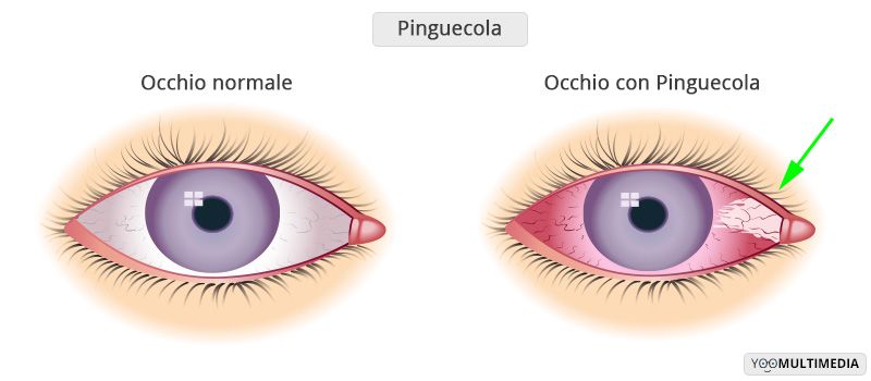 Pinguecola descrizione, sintomi e cure