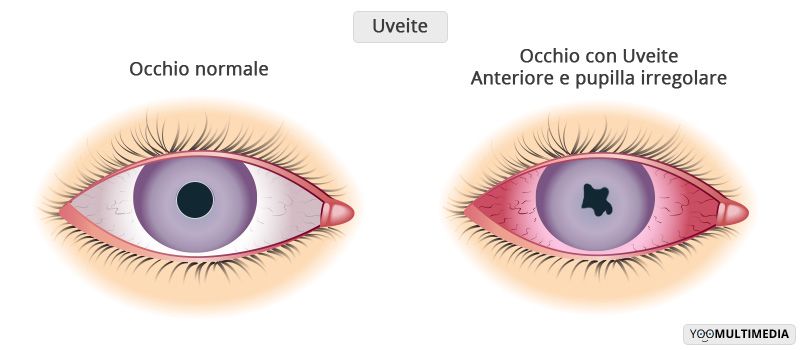 Uveite descrizione, sintomi e cure 