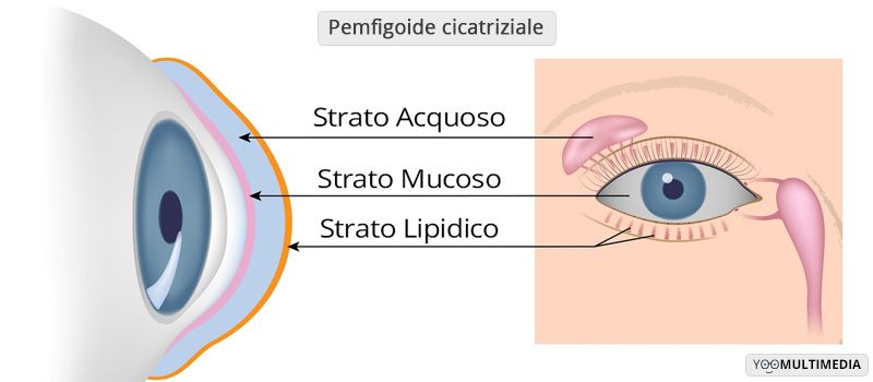 Pemfigoide oculare descrizione, sintomi e cure