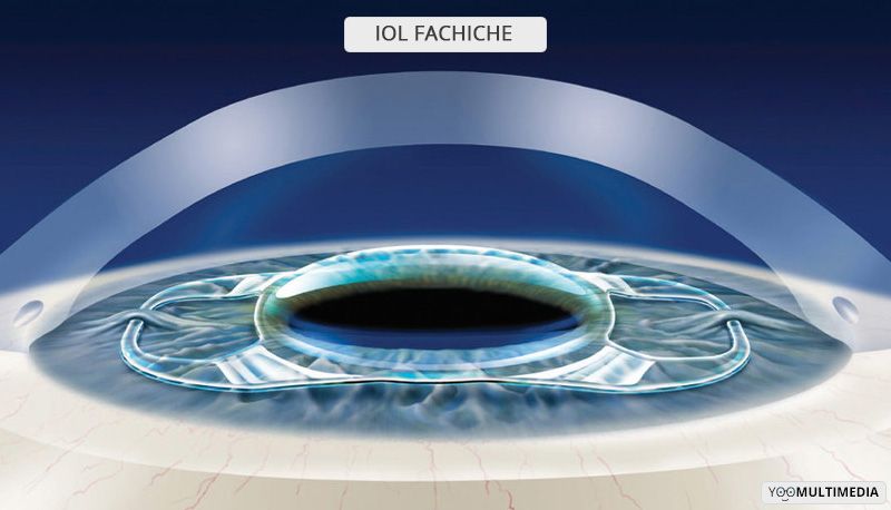 Operazione Miopia Ipermetropia e Astigmatismo elevati con lenti intraoculari fachiche 