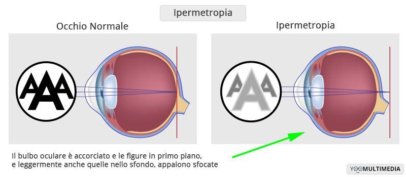 Ipermetropia descrizione, sintomi e cure